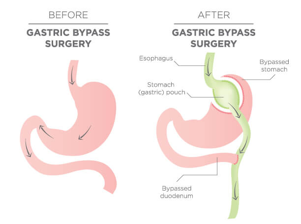 bariatric surgery complications